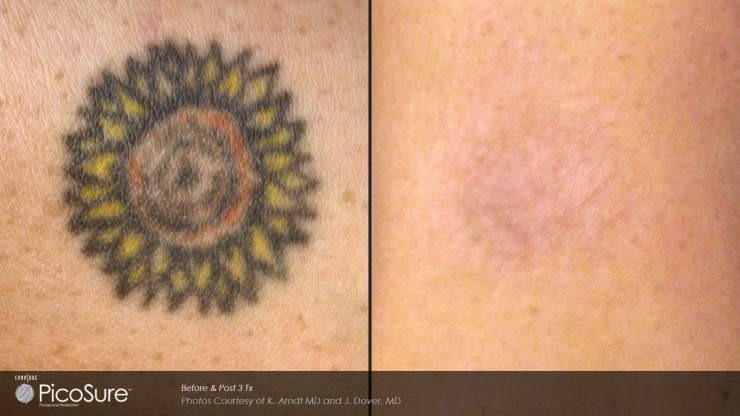Picosure laser tattoo removal in Surrey, near Vancouver