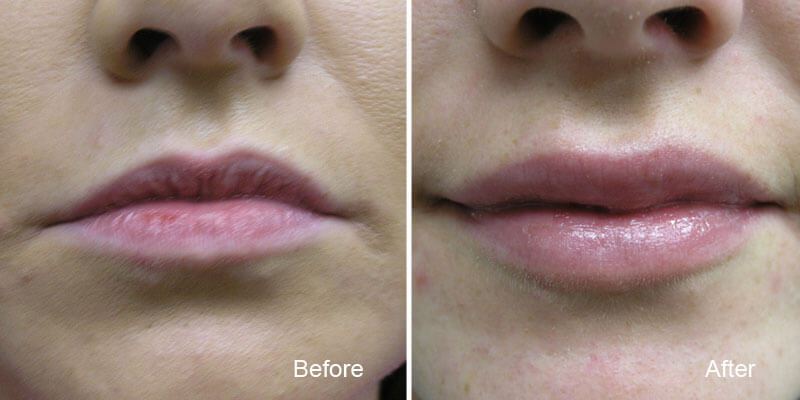 Lip Fillers &amp; Augmentation at BC Laser &amp; Skin Care Clinic ...