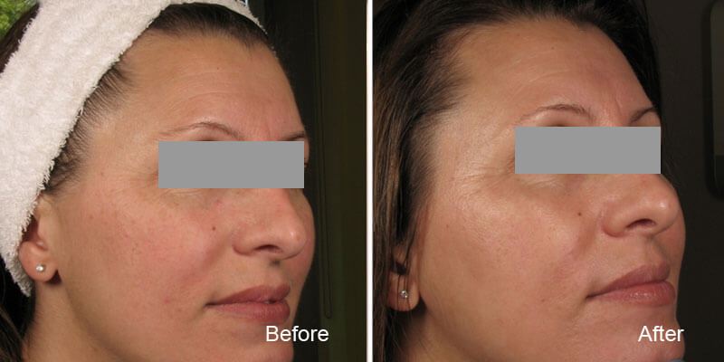 Plasma Skin Resurfacing, Portrait Skin Rejuvenation