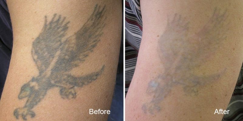 Laser Tattoo Removal Vancouver, Remove Tattoos Safely