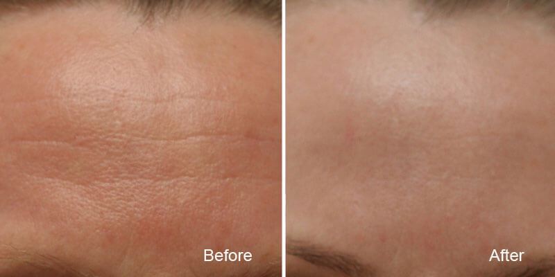 ... removal treatments are one of the more popular treatments at BC Laser