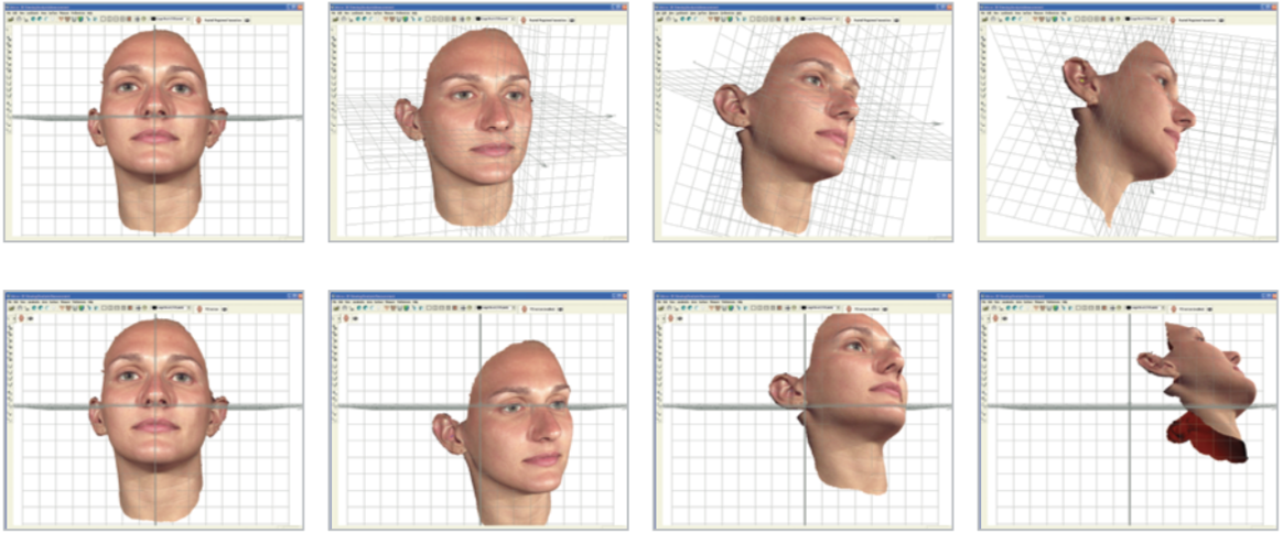 Dimensional views of a patient face for beauty treatments using the Vectra 3D imaging system software