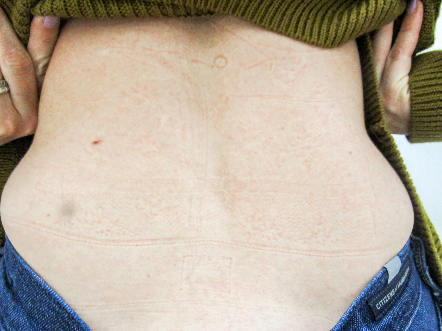 4th treatment with enlighten laser tattoo removal in surrey - back butterfly after photo