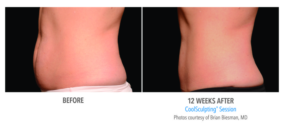 before and after coolsculpting before and after coolsculpting