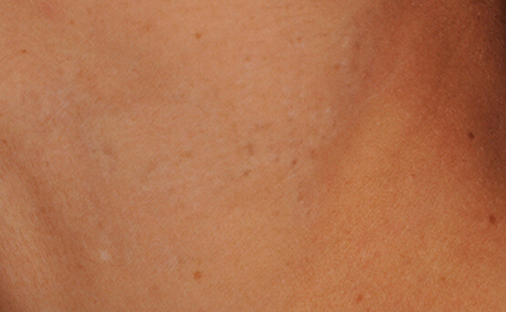 after tattoo removal