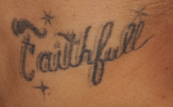 before tattoo removal