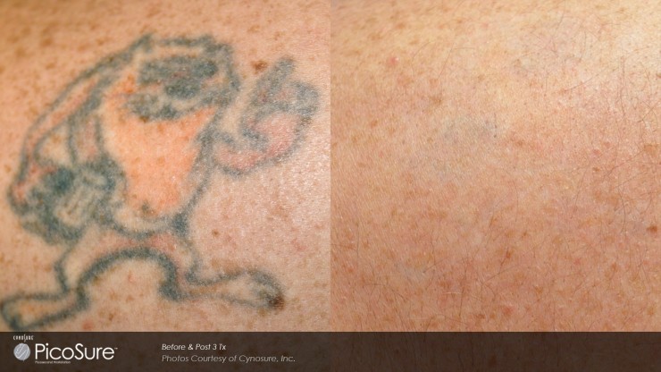 Picosure laser tattoo removal before and after 1