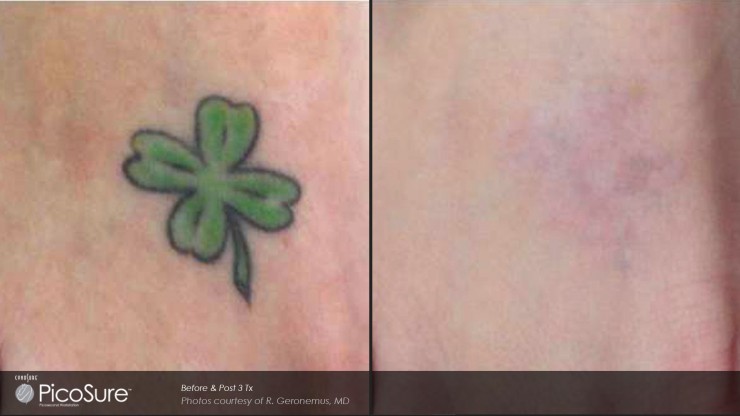 Picosure laser tattoo removal in Surrey, near Vancouver