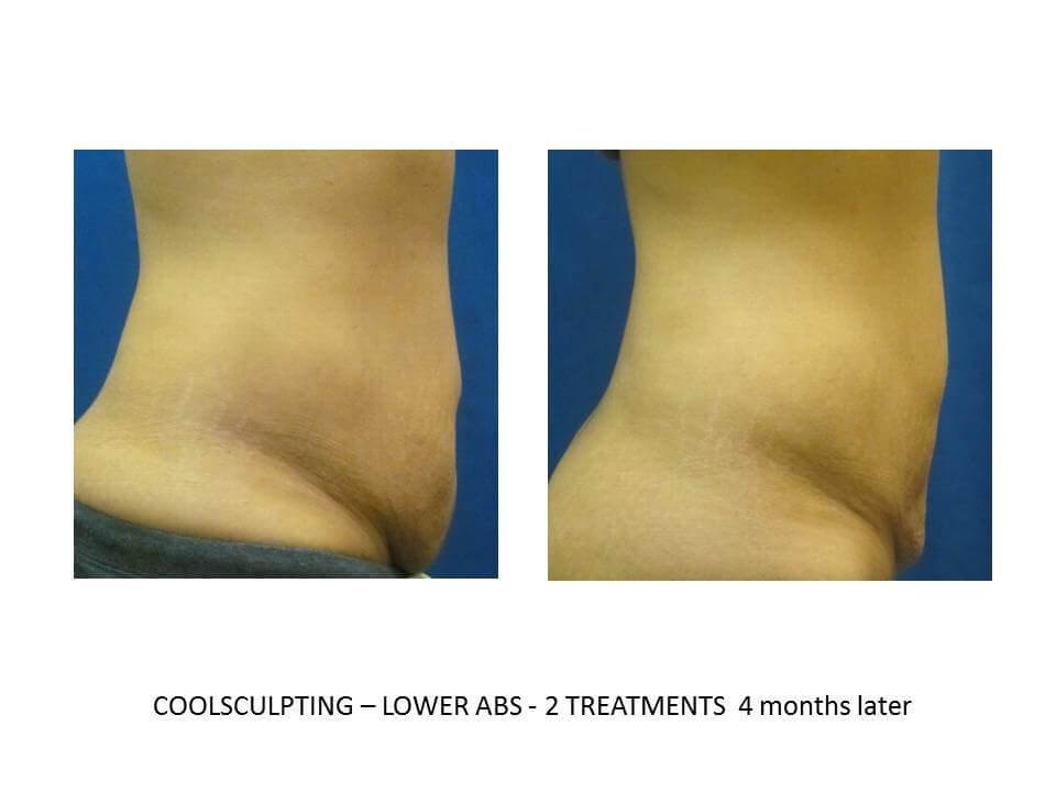 before and after coolsculpting before and after coolsculpting