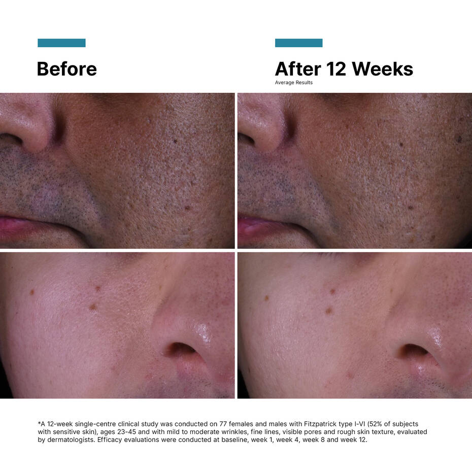 SkinCeuticals P-TIOX Cream Before and After