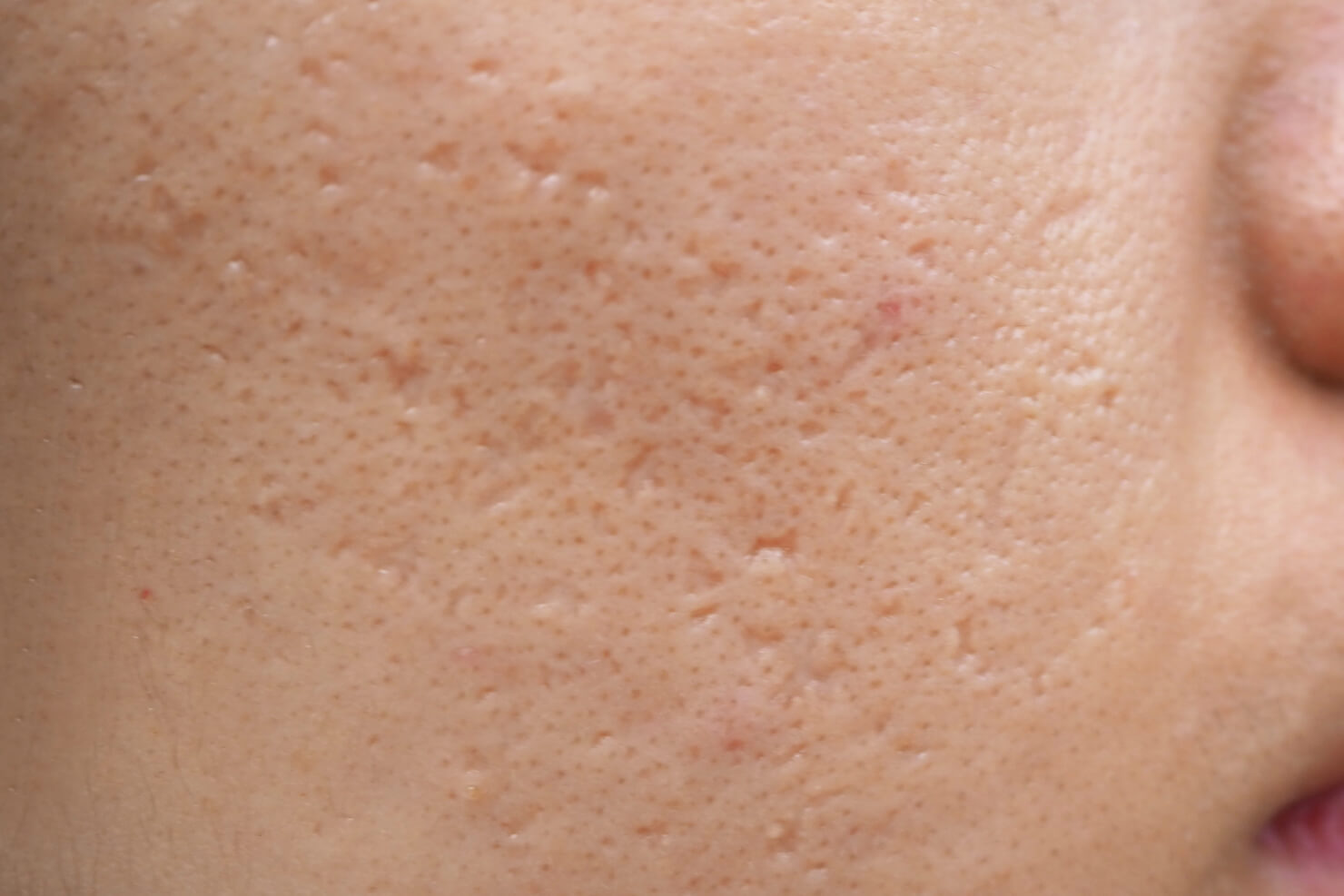 Multiple acne scar types including boxcar and ice pick indented acne scars