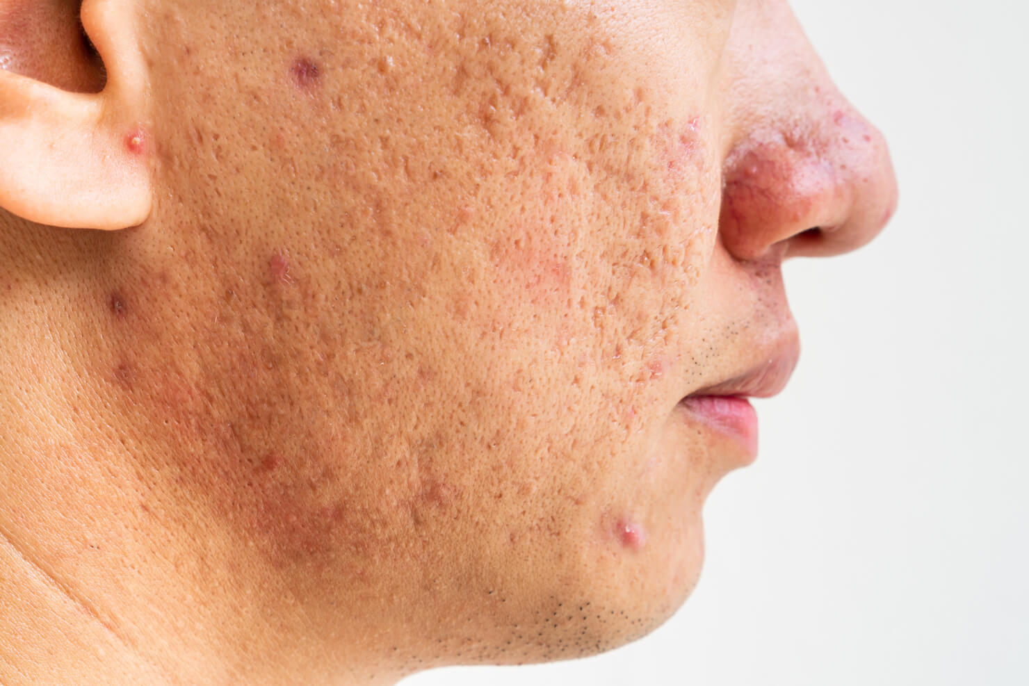 Macular acne scar dark red spot from healing burst blood vessels