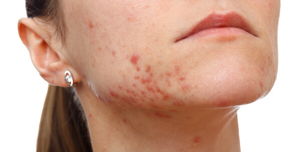 red spots acne and acne scars on jawbone of woman's face