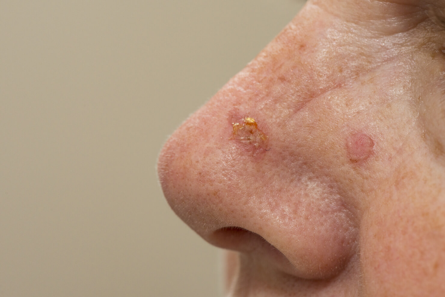 Actinic keratosis on the nose and a treated sun damage spot