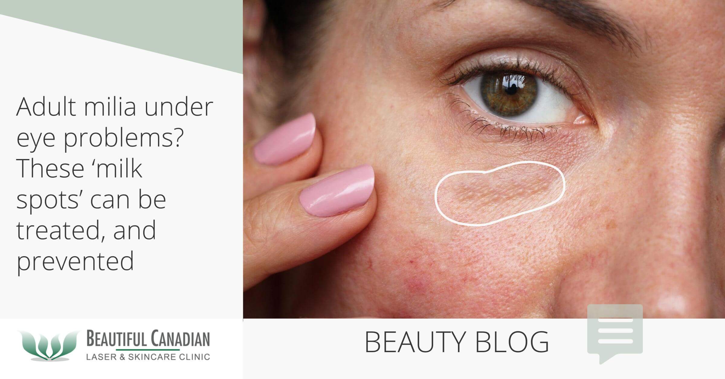 Milia Under Eye Re Under Eye Bumps NOT Milia Page 8 Beauty