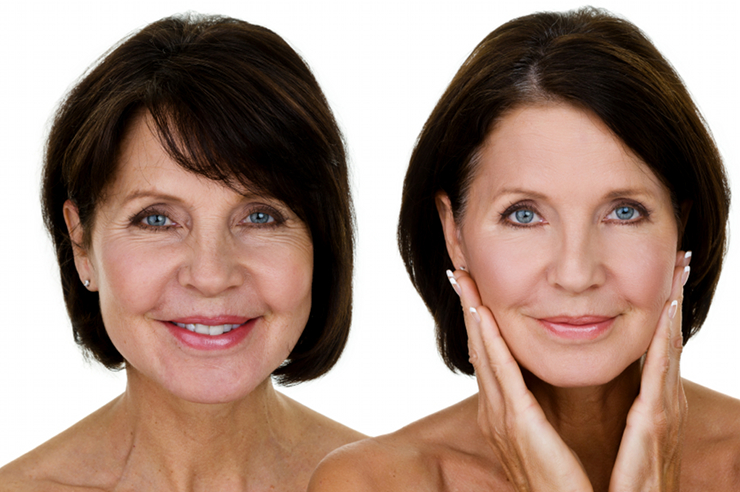 woman with anti-aging treatment showing before and after