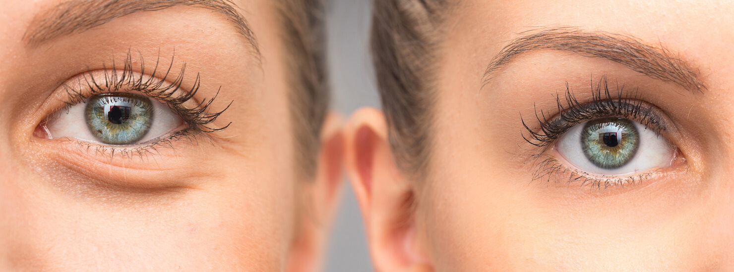 Dark Circles Under The Eyes: Causes & Treatments