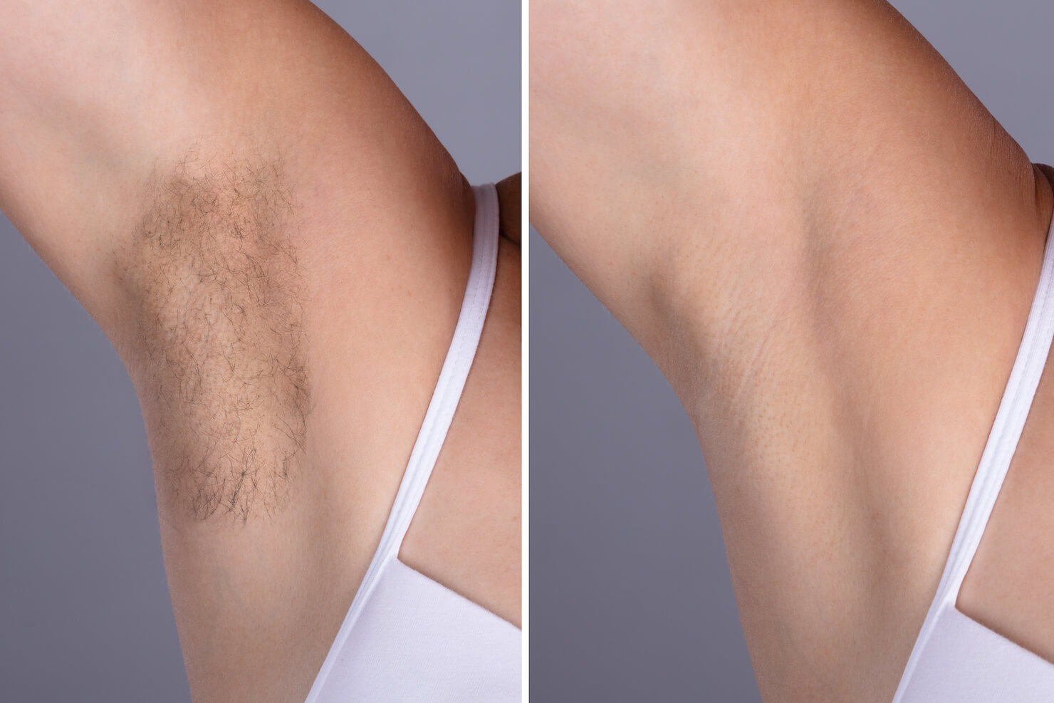 Underarm hair removal before and after example