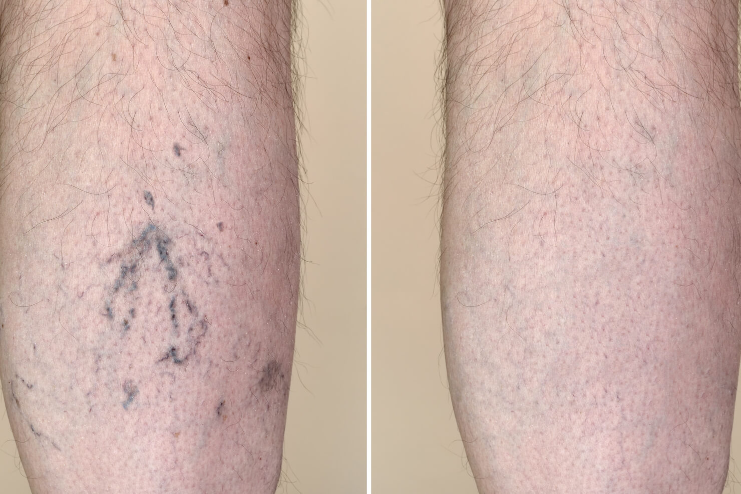 Before and after sclerotherapy or vein removal procedure example