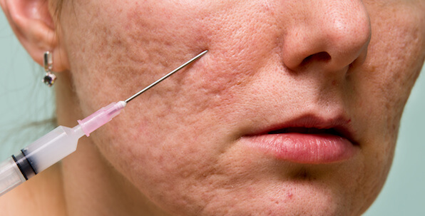 bellafill injections for acne scars and facial filler treatments