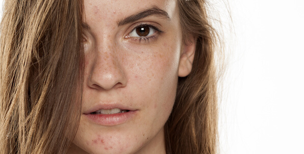 woman's face with freckles and blotchy skin