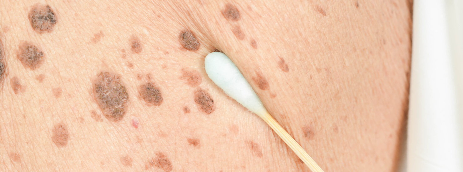 brown spots mole removal inspection 1480x550 1