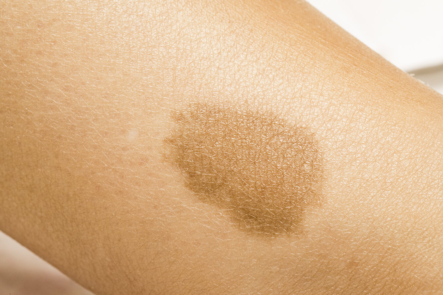 Cafe au lait birthmark flat oval brown birthmark skin pigmentation issue