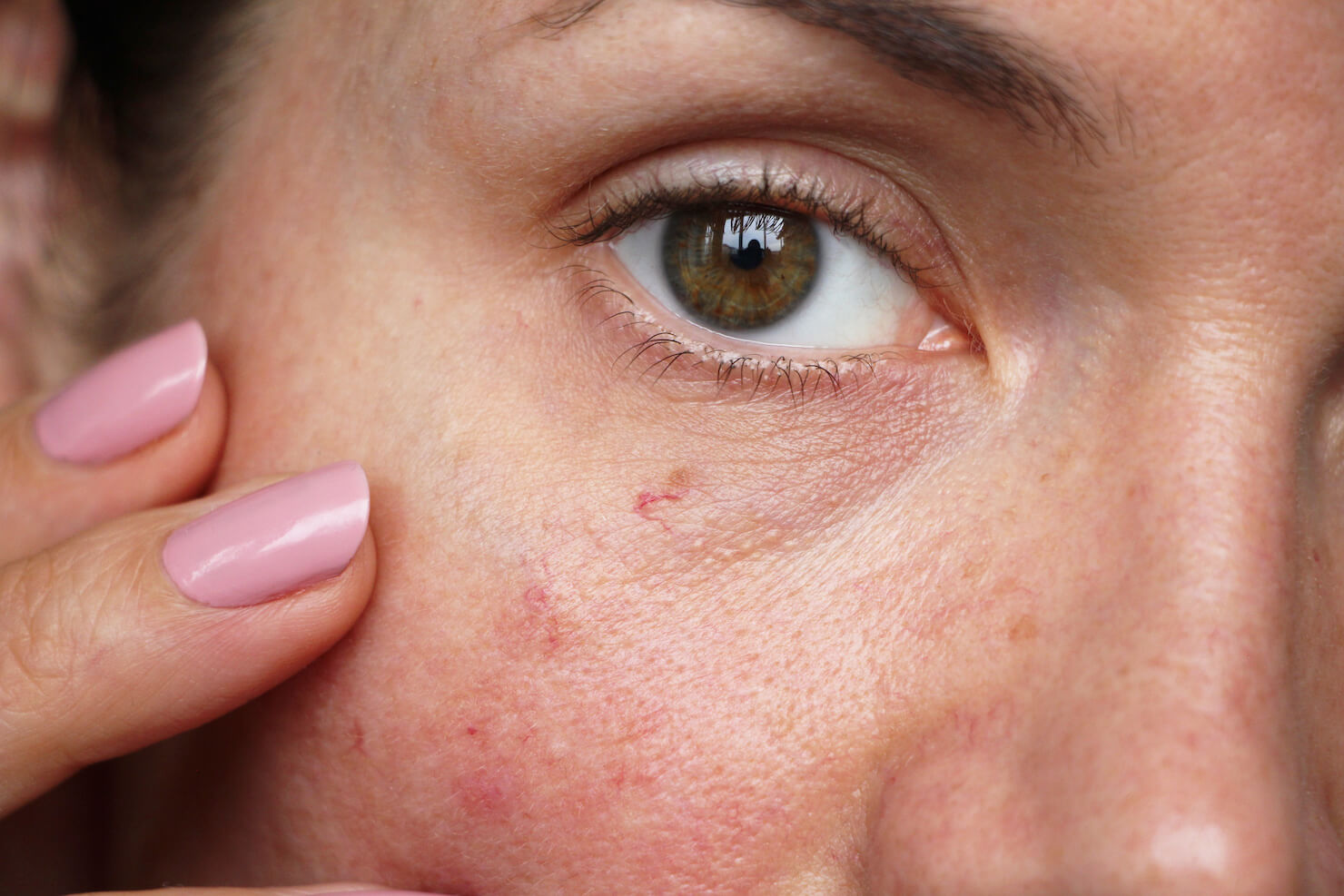 Erythema red spots from broken capillaries resulting from sun damage
