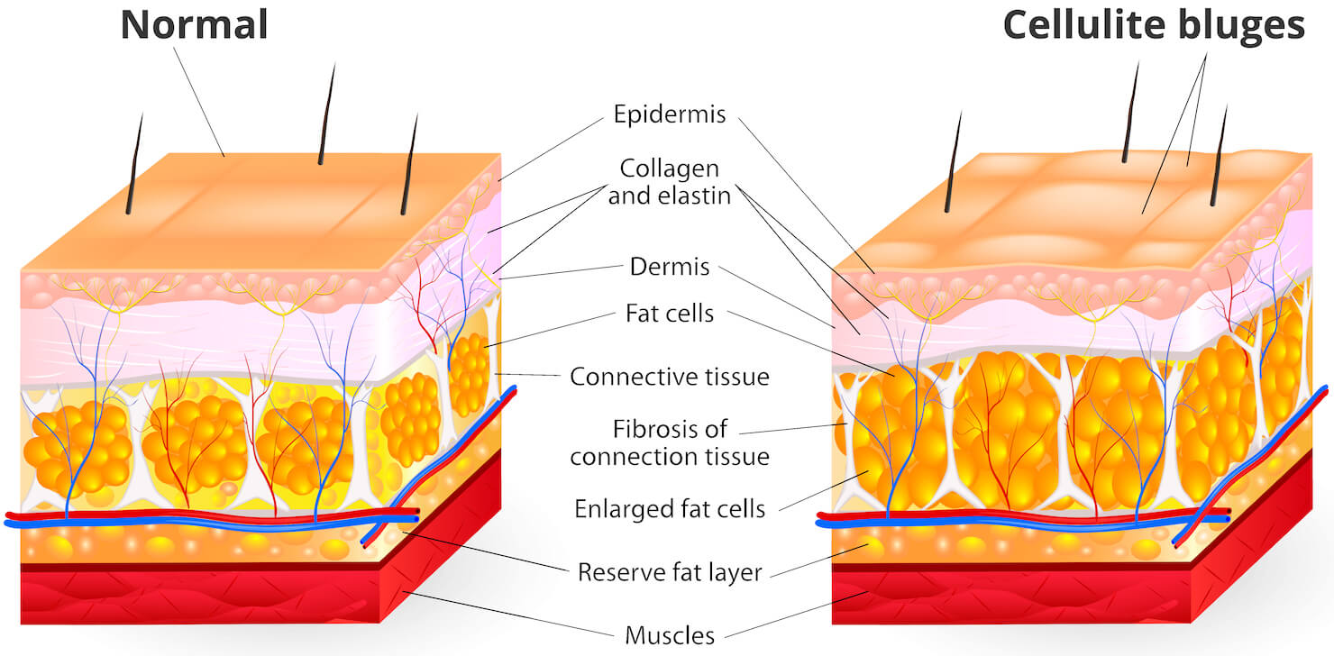 cellulite formation diagram - fat bulges under skin
