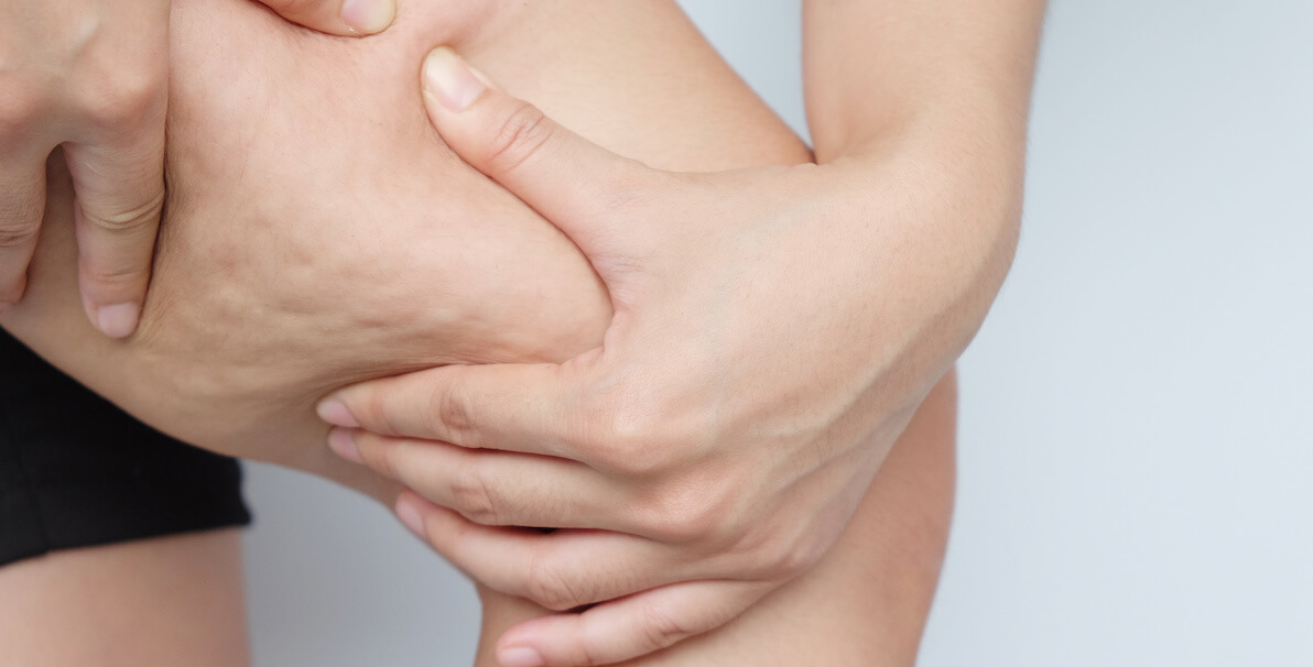 cellulite on thigh squeezing to show dimpled skin