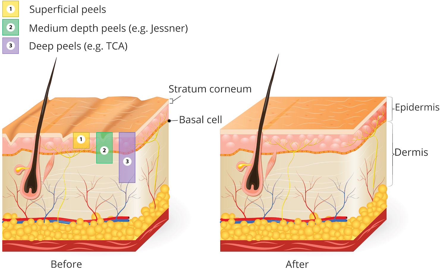 chemical peel strengths diagram for explanation on surrey medium strength face peels