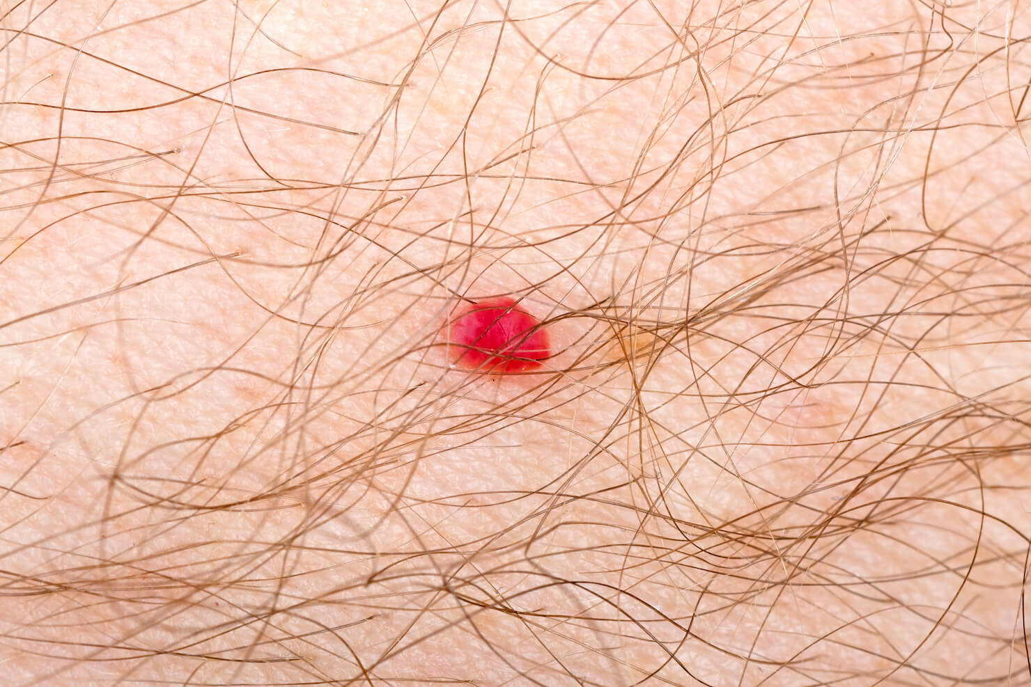 Cherry angioma red mole on skin beneath hair removable red spot condition