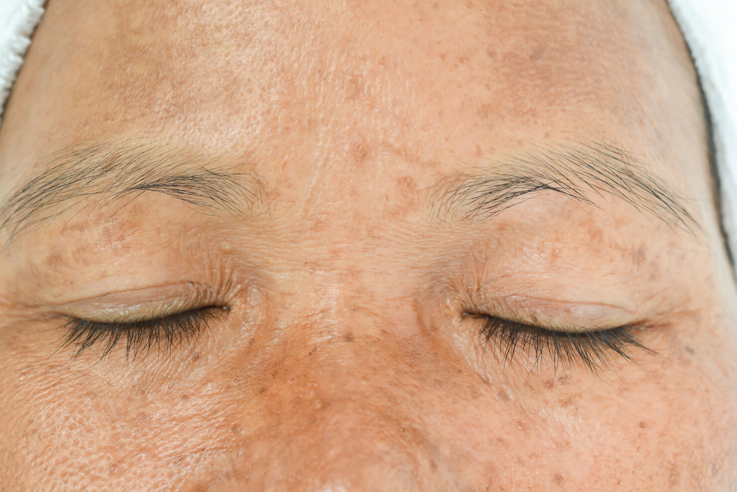 Melasma and brown patchy skin or freckles from sun damage