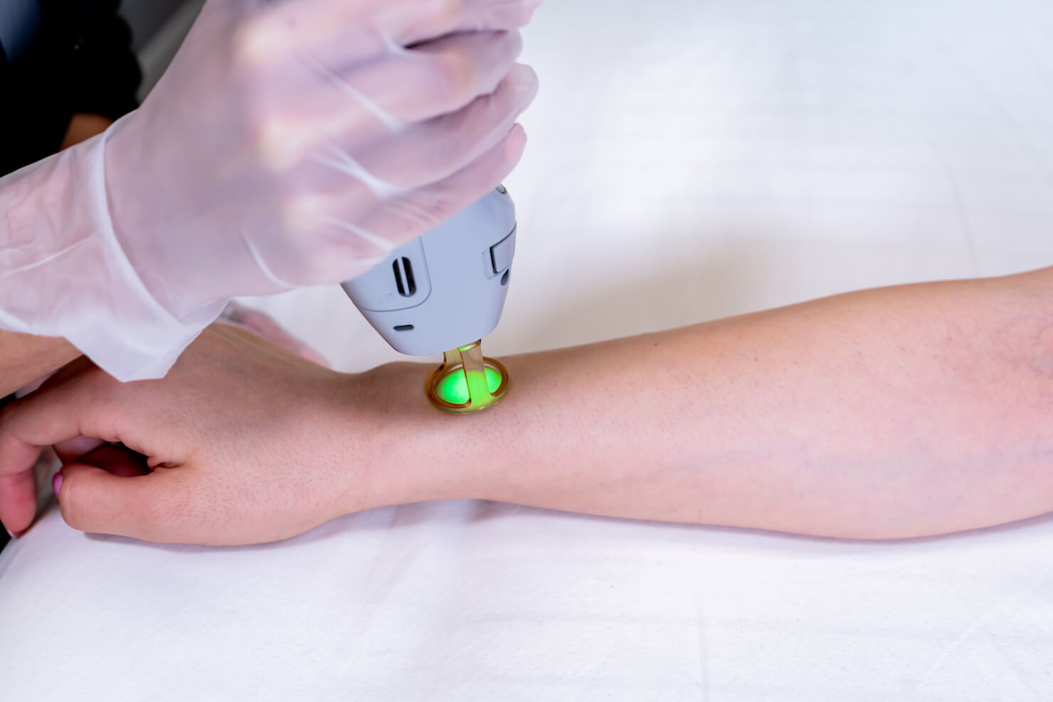 close up of laser hair removal in surrey on patient arm