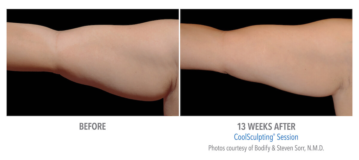 arm fat removal with CoolSculpting example - before and after photos