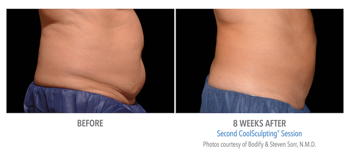 belly fat removal with CoolSculpting freezing fat technology - before and after photos