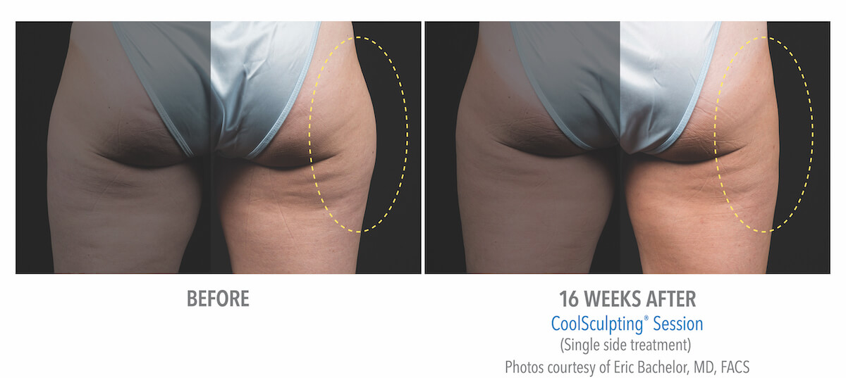 hip leg fat removal with CoolSculpting machine - before and after photos