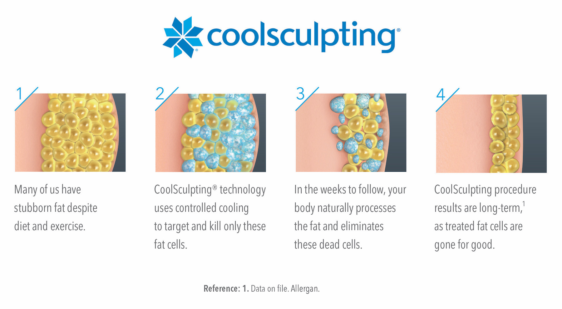 how coolsculpting works diagram - way to freeze fat cells for non-surgical liposuction