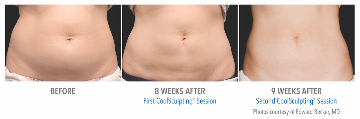 fat freezing with CoolSculpting progress images - abdomen results