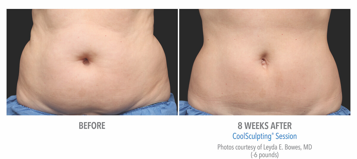 belly fat removal with CoolSculpting before and after photos