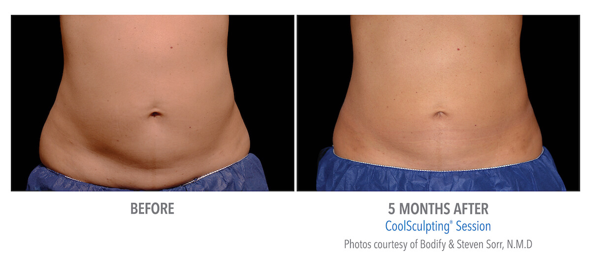 unwanted stomach fat removed with CoolSculpting machine technology - before and after photos