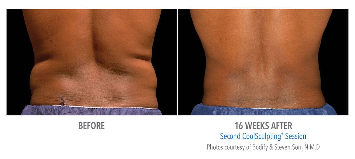 back fat removed with CoolSculpting machine - before and after photos