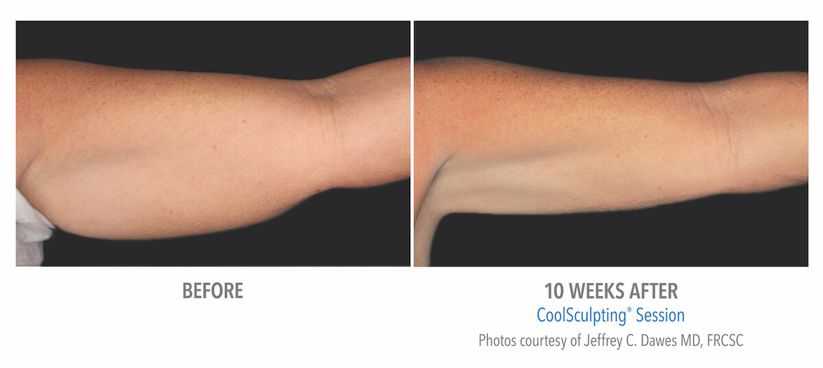 arm flab removed with CoolSculpting technology to freeze fat - before and after photos