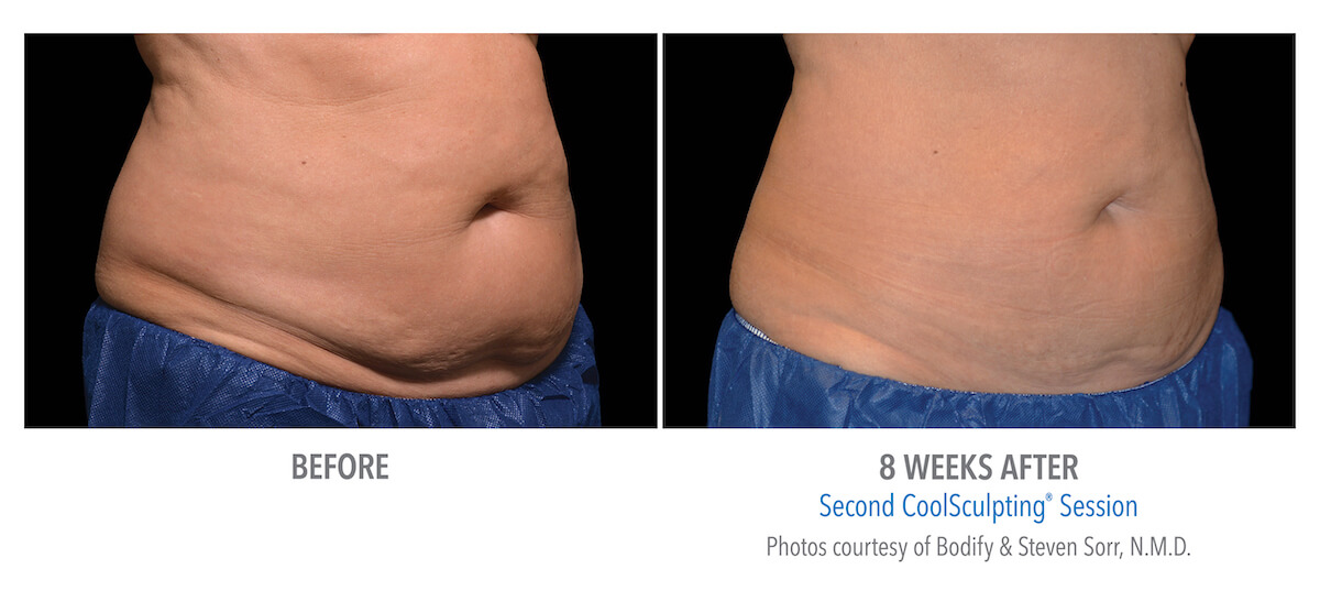 excess fat removal before and after photo by freezing fat away with CoolSculpting