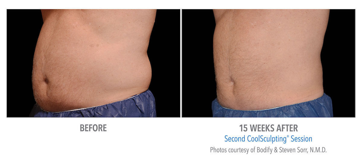 Abdomen fat removal with CoolSculpting - before and after photos
