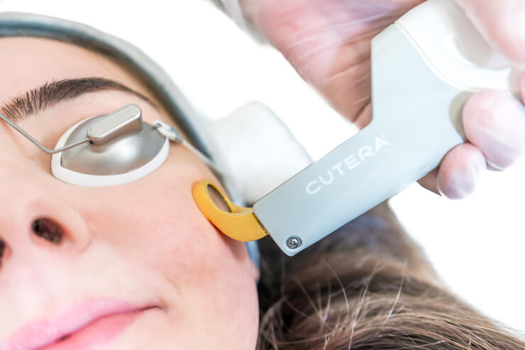 cutera excel v handpiece during skin laser treatment on white background with female patient