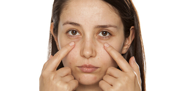 woman pointing to dark puffy under eye circles on face