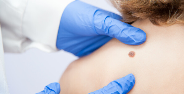 doctor hands examining birthmark on back shoulder of woman