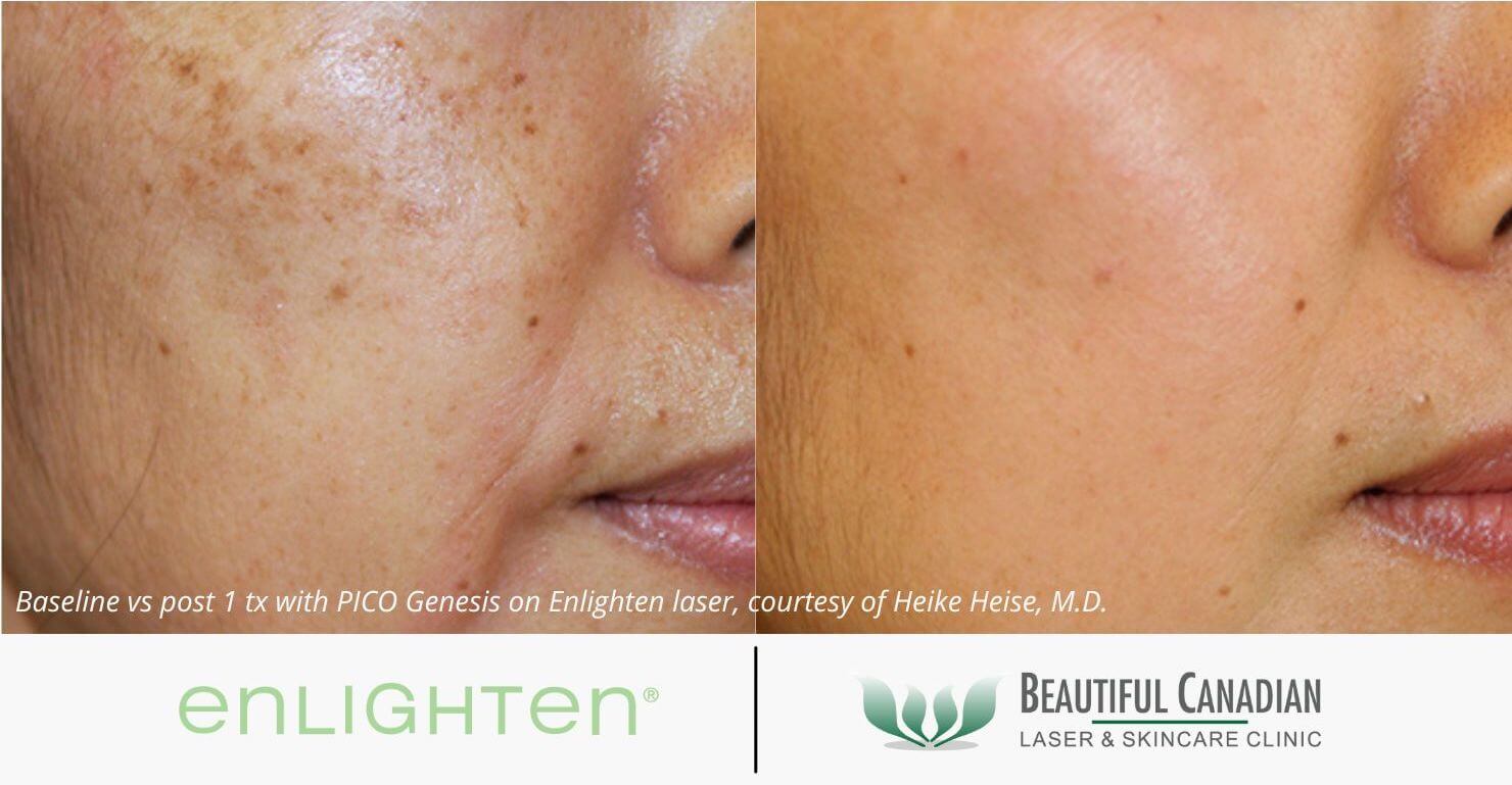 Vancouver Melasma Treatments (in Surrey) Using Lasers, Facials + More