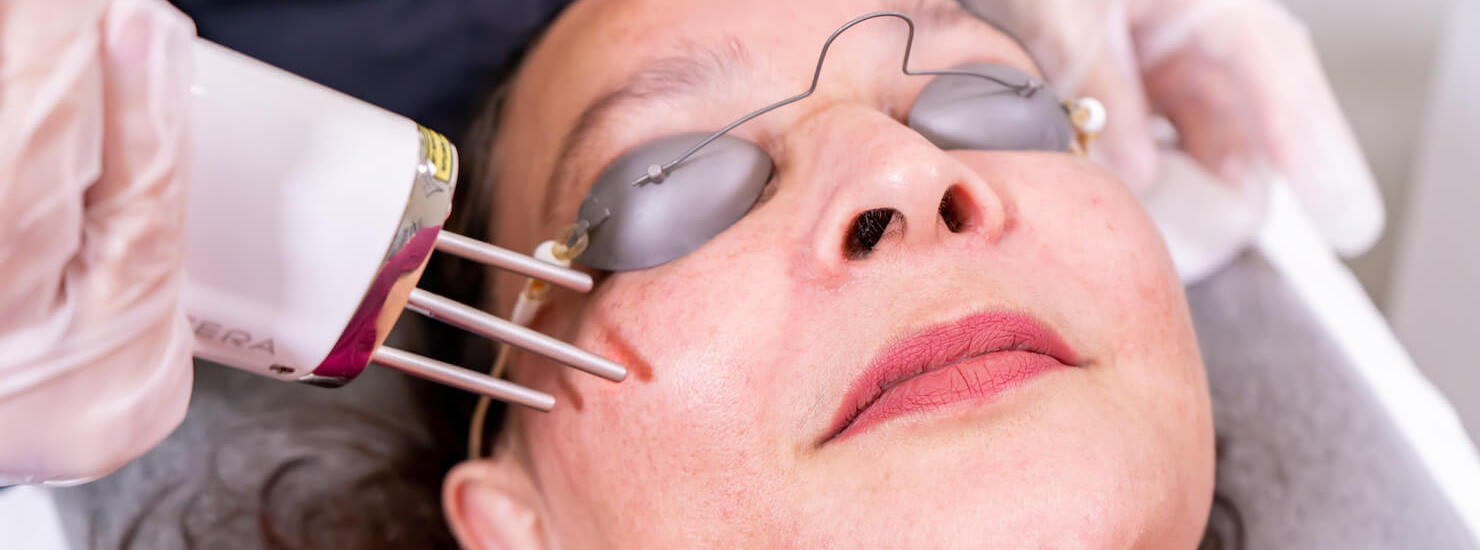 Laser Resurfacing For Better Skin: Things You Must Know, 49% OFF